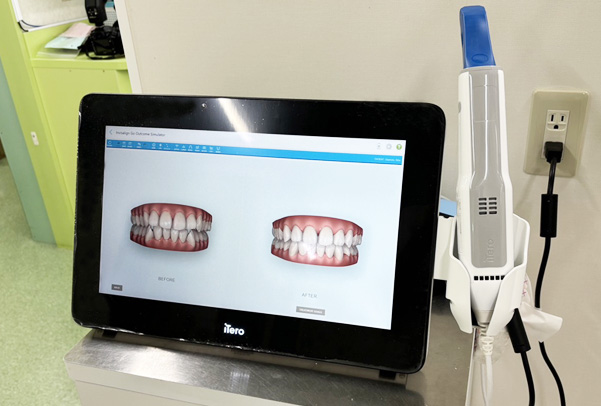 3Dスキャナー iTero Element