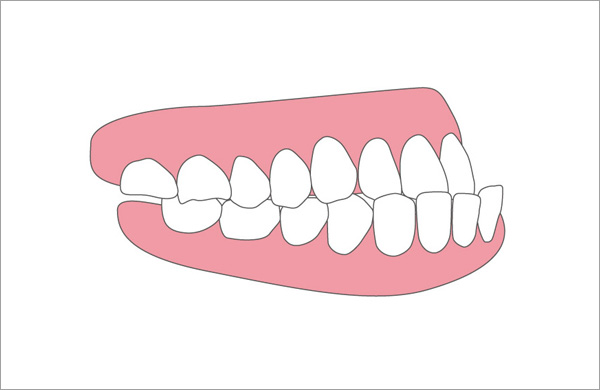 上顎前方けん引装置