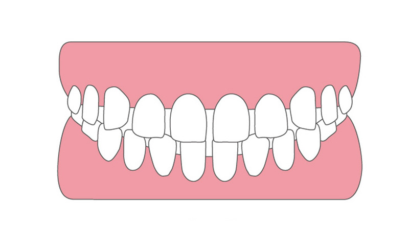 すきっ歯（空隙歯列）