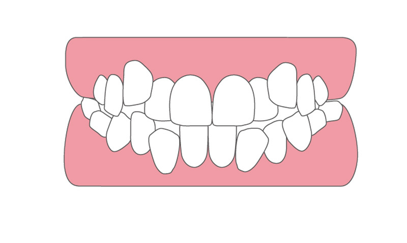 八重歯・叢生