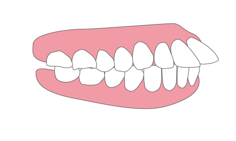 出っ歯（上顎前突）