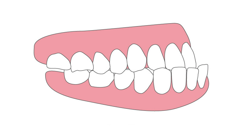 受け口（下顎前突）