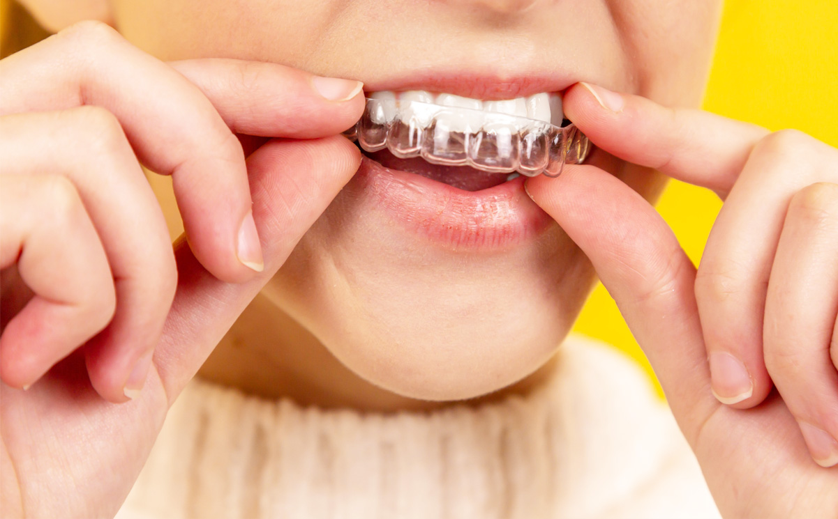 インビザライン