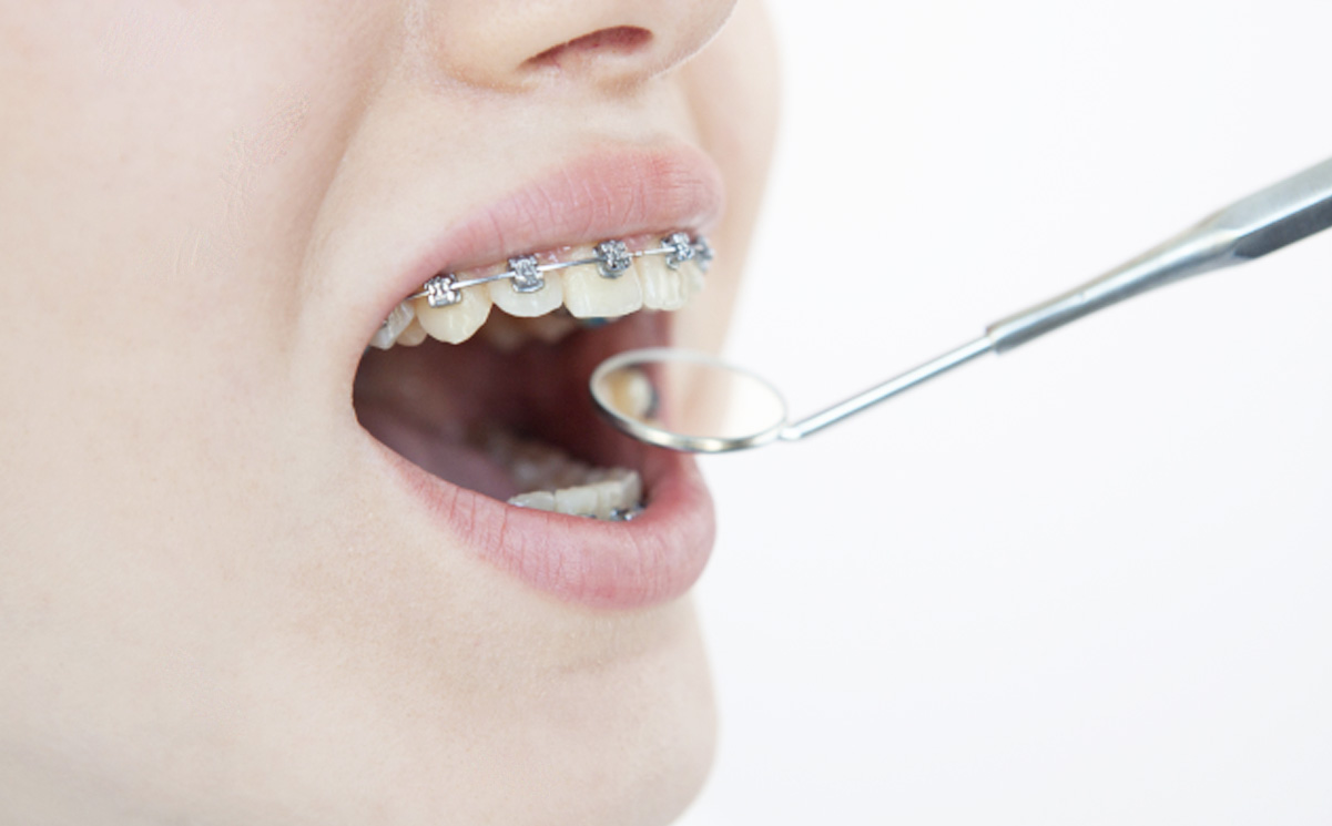 部分矯正（MTM）