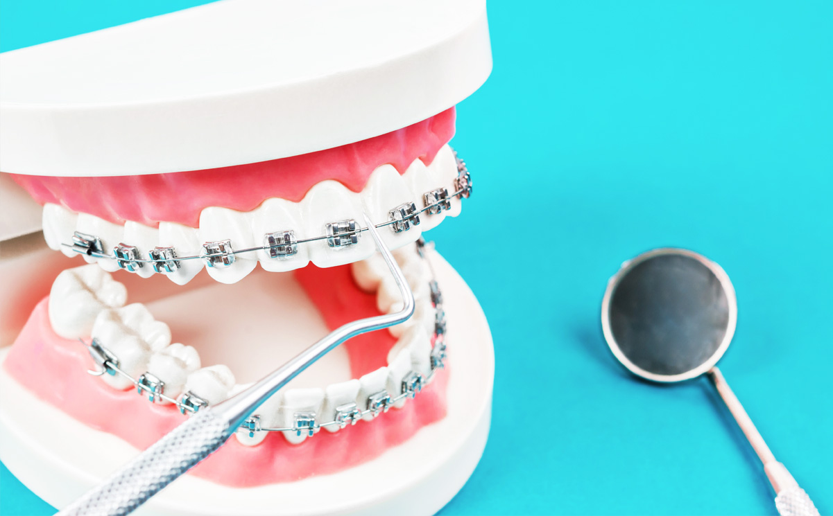 表側矯正のメリット