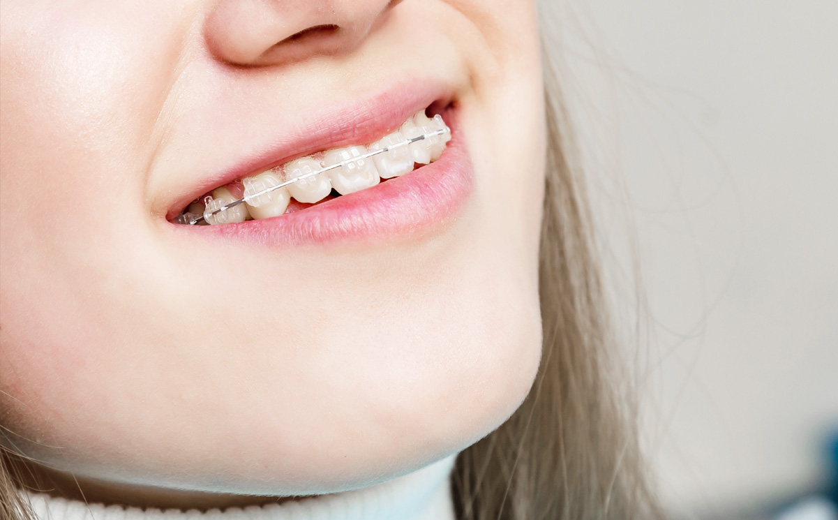 表側矯正のメリット