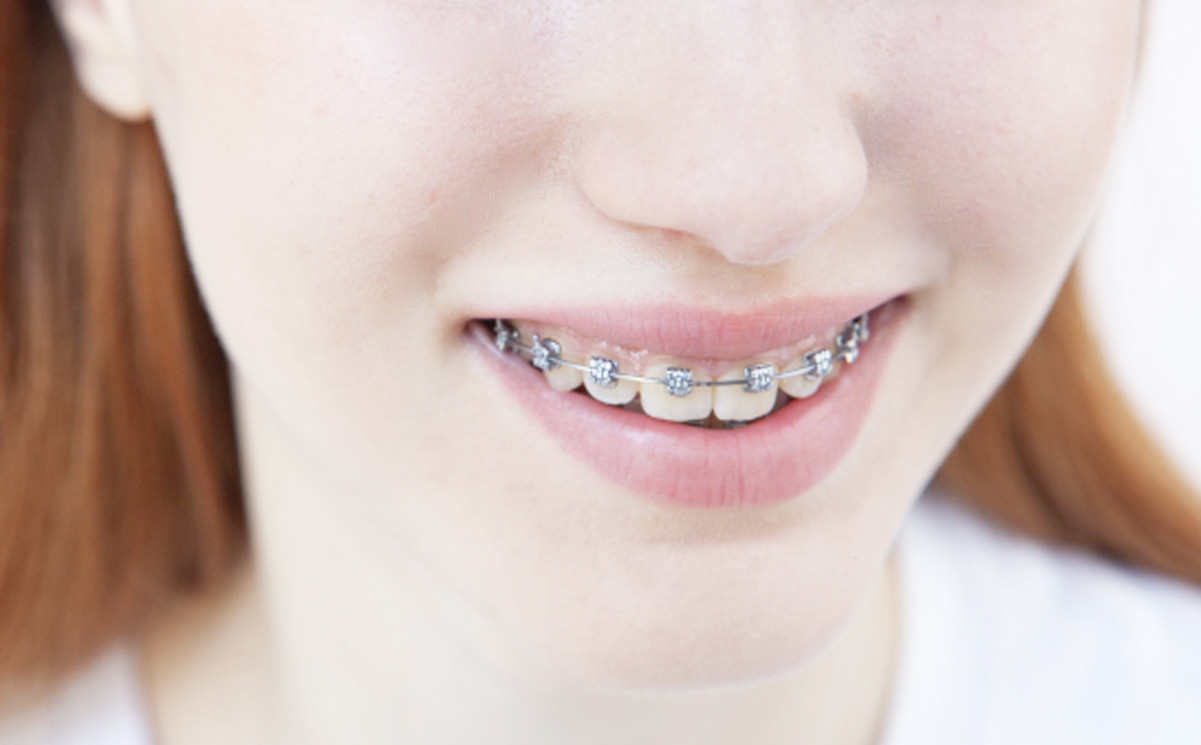 メタルブラケット