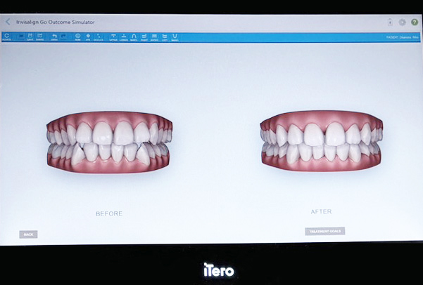 デジタル 3D スキャニングiTero エレメントを導入