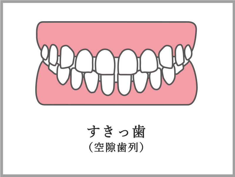 すきっ歯