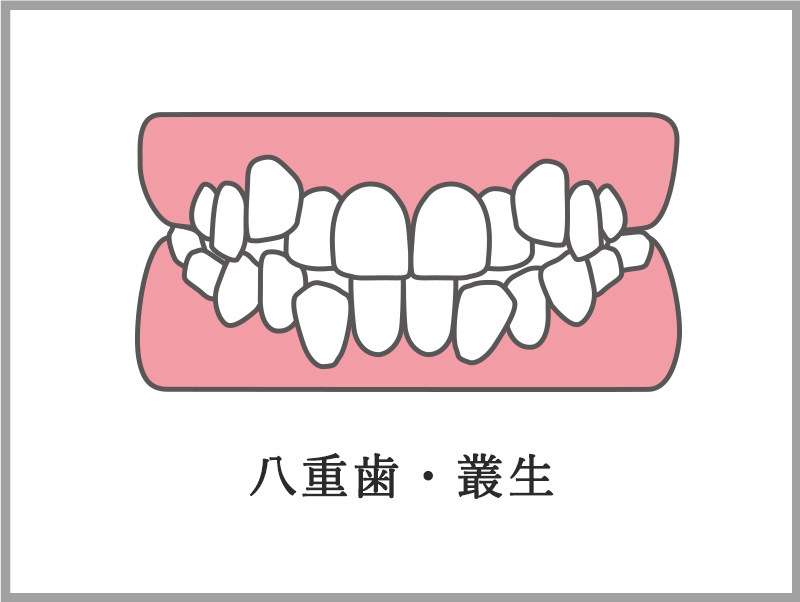 八重歯叢生