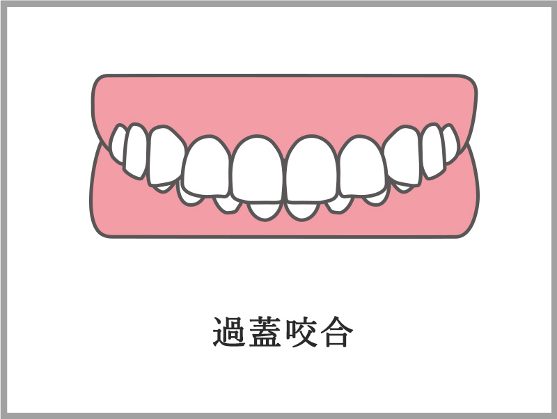 過蓋咬合