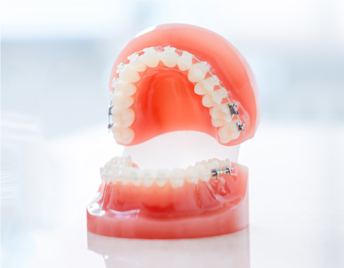 MTM（部分矯正）