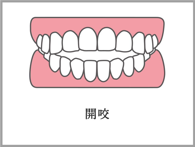 開咬